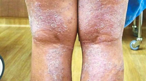 A patient with severe atopic dermatitis, also known as eczema.