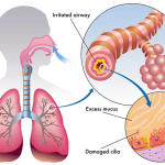 Allergic Bronchitis Treatment at HomeoEclinic